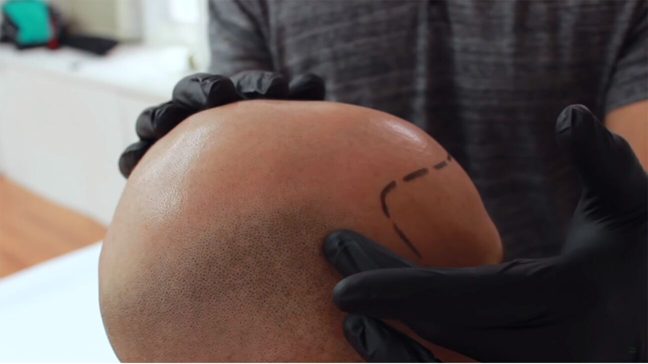 Scalp Micropigmentation Ajax, Durham, GTA | Dr. Hair Tattoo