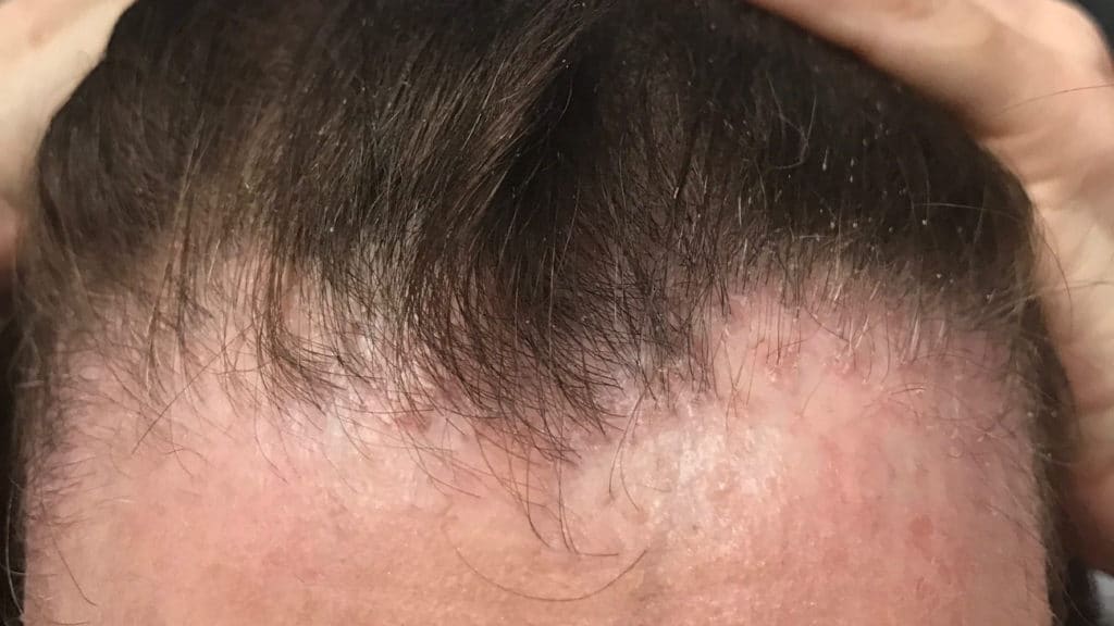 Frontal Fibrosing Alopecia: Causes and Treatment - Hairverse