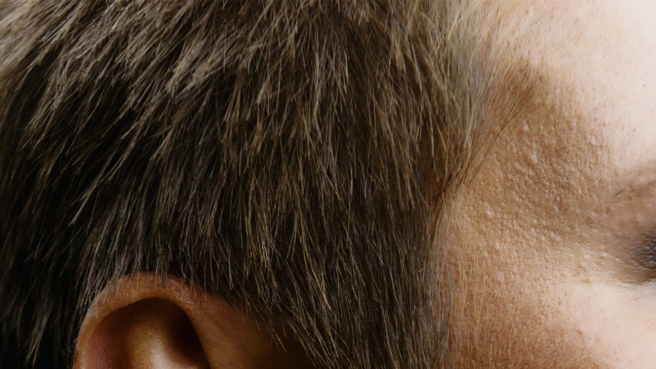 Prostaglandins Hair Growth: A Hair Loss Treatment? -