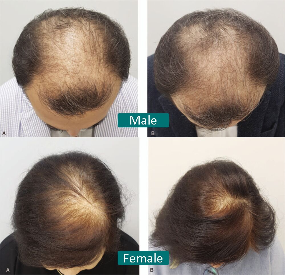 Premium Vector  Stages of baldness of men and women male and female  characters head top side and front view with hair loss process